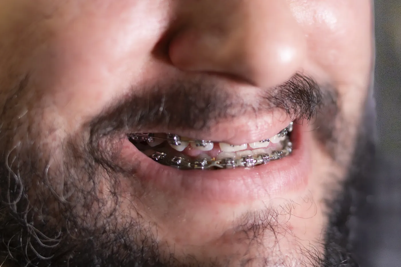 Sorriso de paciente com aparelho ortodôntico