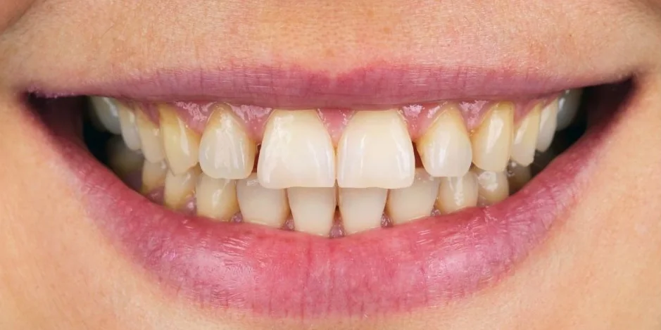 Sorriso antes: lentes de contato dental