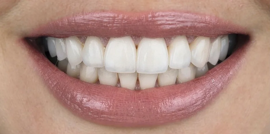 Sorriso depois: lentes de contato dental