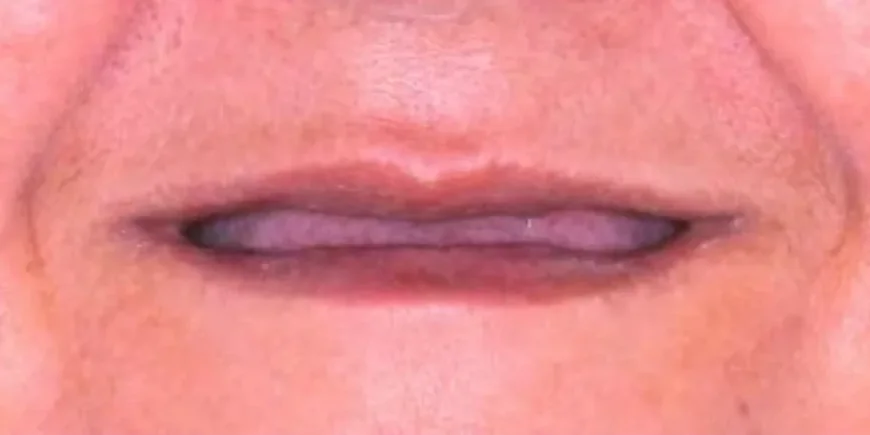 Sorriso antes: reabilitação oral completa