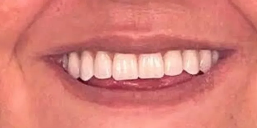 Sorriso depois: reabilitação oral completa